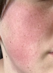 Rash on face