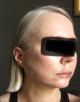 My droopy jowl mini face lift result pics