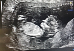 Gender Predictions from Scan today