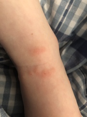 Bed bugs or midget bites or something worse - photos inc.
