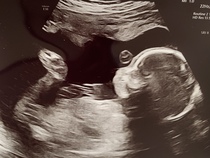 👣 Due Nov/Dec 👣 it's the 20 week scans! 👣