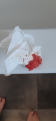 Help. Bleeding