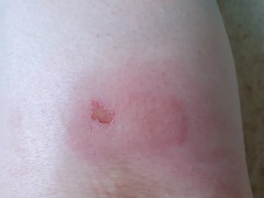 What has bitten me?