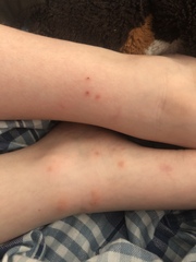 Bed bugs or midget bites or something worse - photos inc.