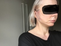 My droopy jowl mini face lift result pics