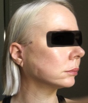 My droopy jowl mini face lift result pics