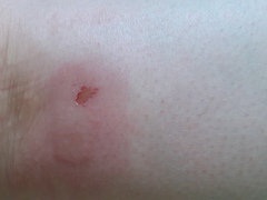 What has bitten me?
