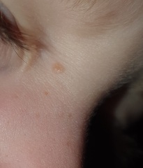 What is this on my son's face please?
