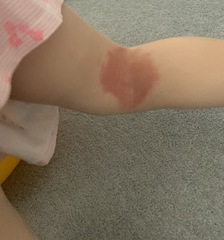 Eczema?