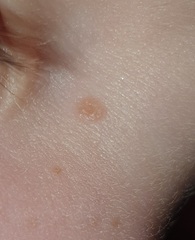 What is this on my son's face please?