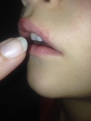 Cold sore? Impetigo? Reaction?