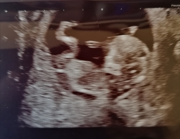 Is the nub visible here? Finding out sex today and want to hear guesses in the meantime!