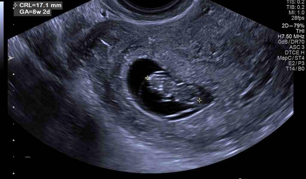Pregnancy after MMC