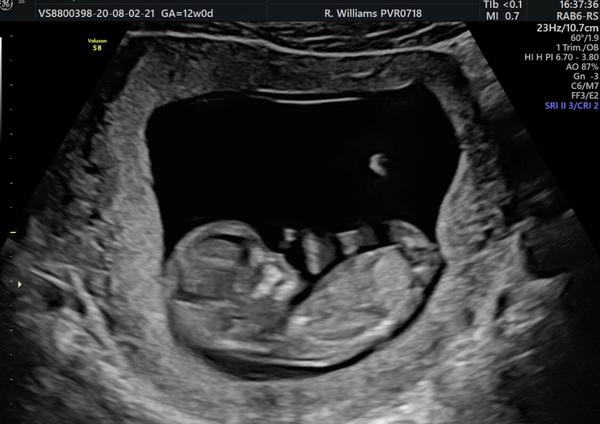 12 week scan nerves