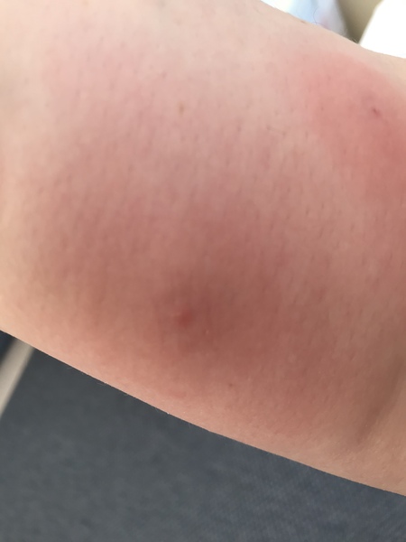 AIBU to think this is not a normal midge bite?