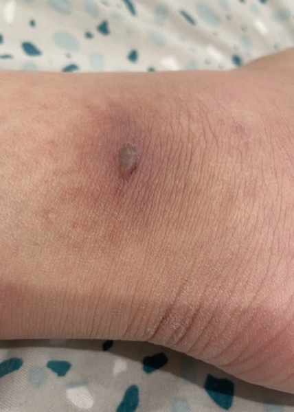 Insect bite with pictures