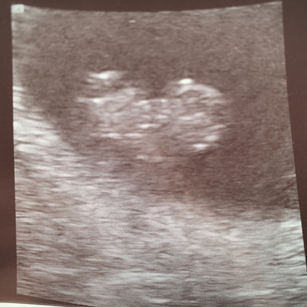 Pregnant after Missed Miscarriage MMC