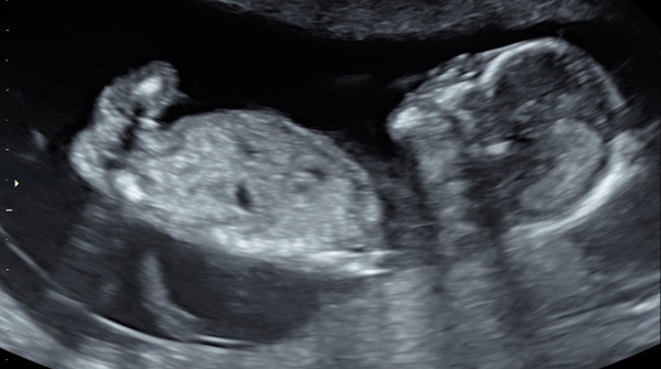 Gender guess please 14weeks xx