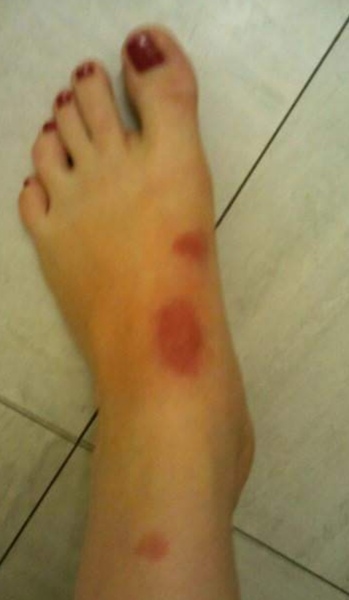 What's the worst sting or bite you've ever had?