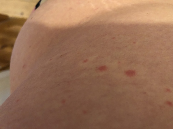 Any idea what this rash may be?