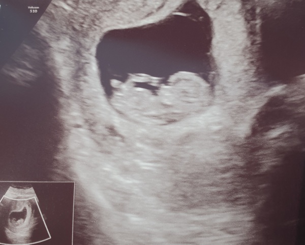 Pregnant after Missed Miscarriage MMC