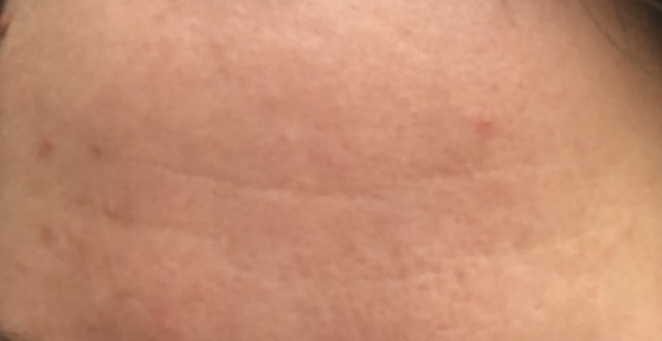 Is Botox my only hope?