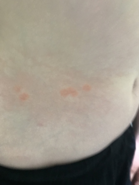 AIBU to ask you to identify this rash on DS