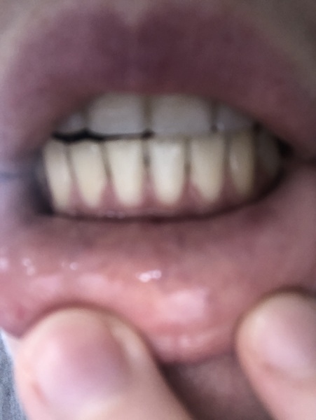Can't stop thinking about receding gums, I'm terrified - any advice? - Photos inc