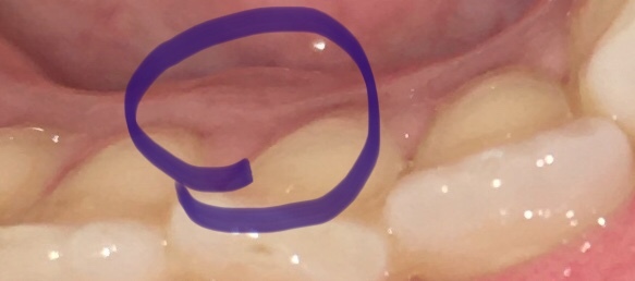 Any dentists around? Worried oral cancer.