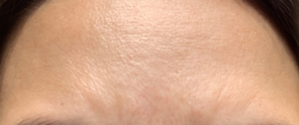 What to do about frown forehead lines that isn’t surgery? (I’m 40)