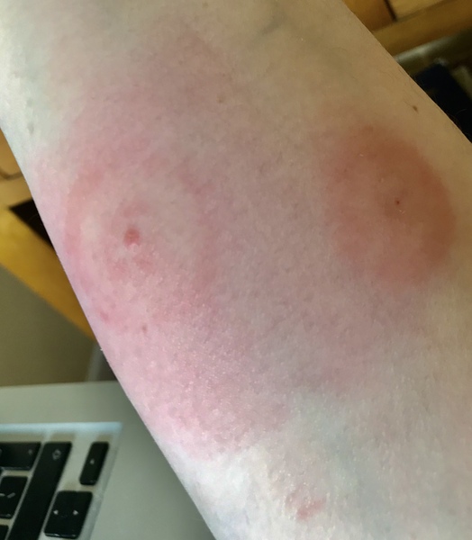 AIBU to think this is not a normal midge bite?