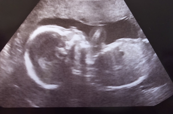Boy or girl?!