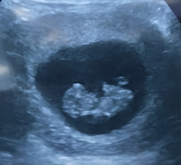 Early scan - experiences