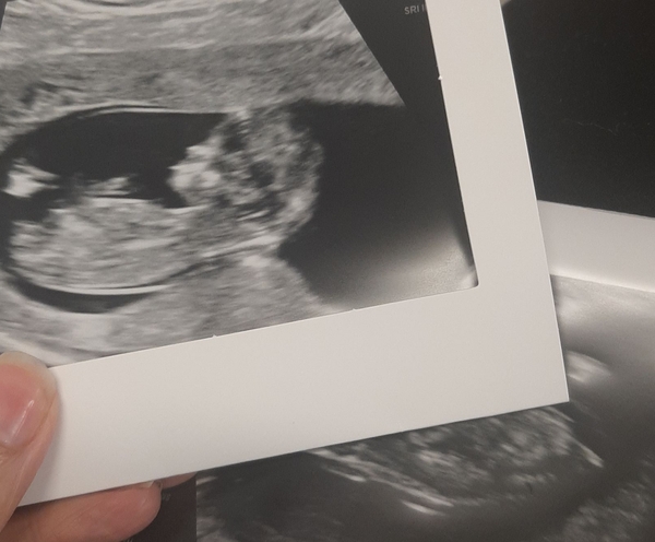 Pregnancy after MMC