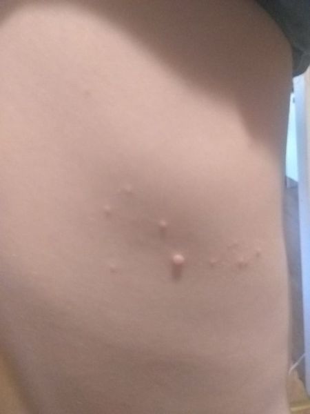 Another rash thread