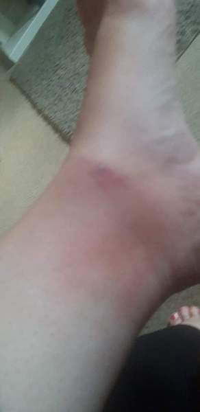 Bite turning black..help