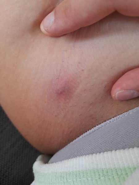 Is this a spot, an ingrowing hair...