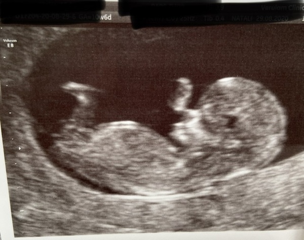 Pregnant After MMC - Thread 2