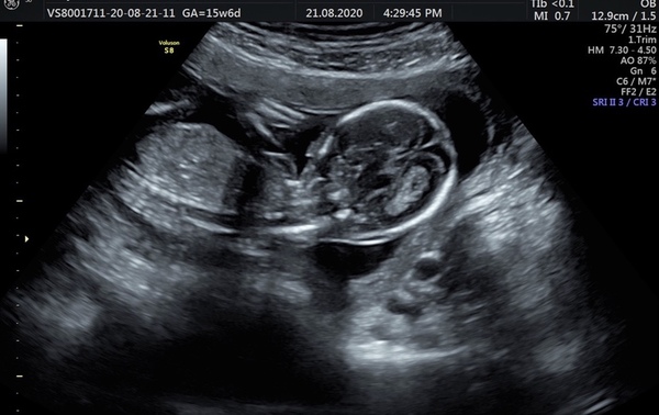 How do you cope between 12 and 20 weeks?