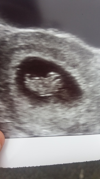 Pregnant after Missed Miscarriage MMC
