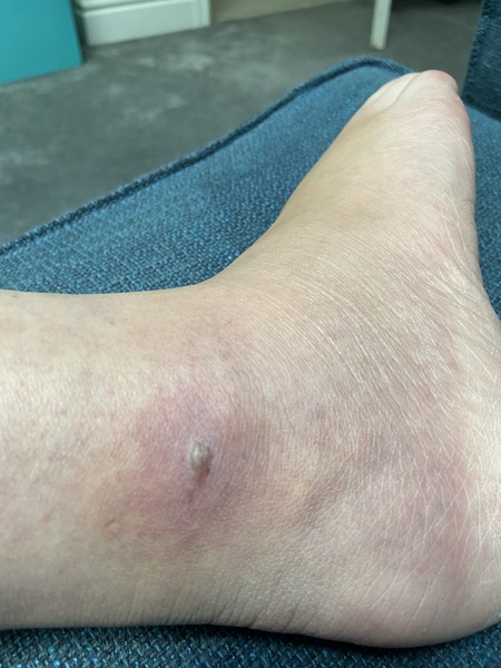 Insect bite with pictures