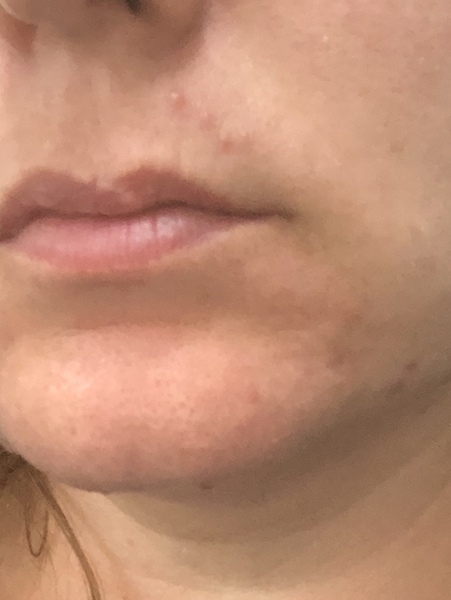 Spots/acne after facial hair remover with twiddly thing/manual epilator