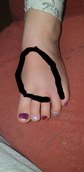 Dd stung by something, redness spread quickly