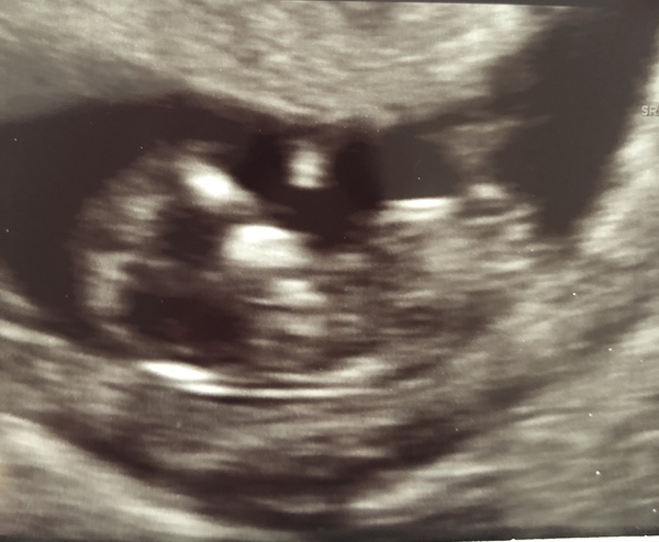 Pregnant after Missed Miscarriage MMC
