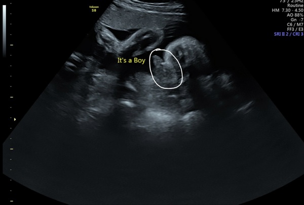 Can a gender scan be wrong?