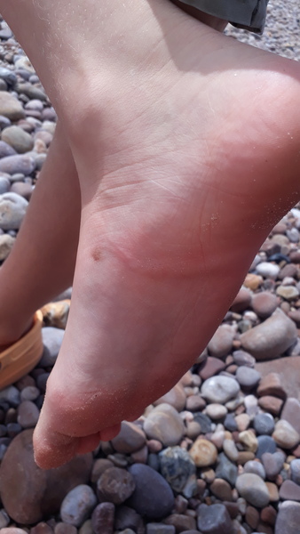 Identify a marine creature sting please. Jellyfish or weever?