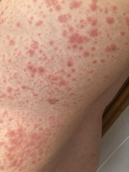 Any idea what this rash may be?