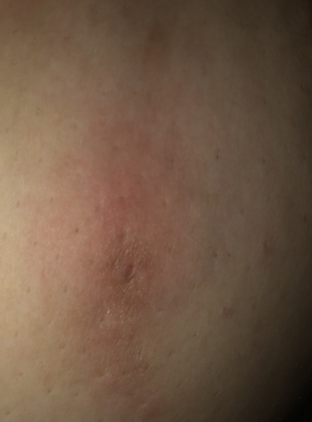 Weird spot on Side of breast