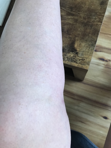 Why are my legs swollen? Pics