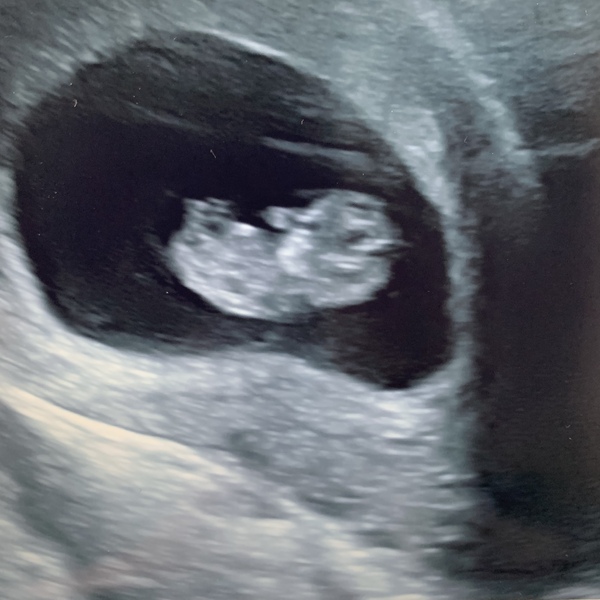 Pregnant After MMC - Thread 2